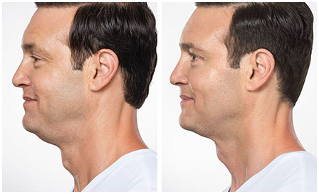 kybella double chin treatment before and after